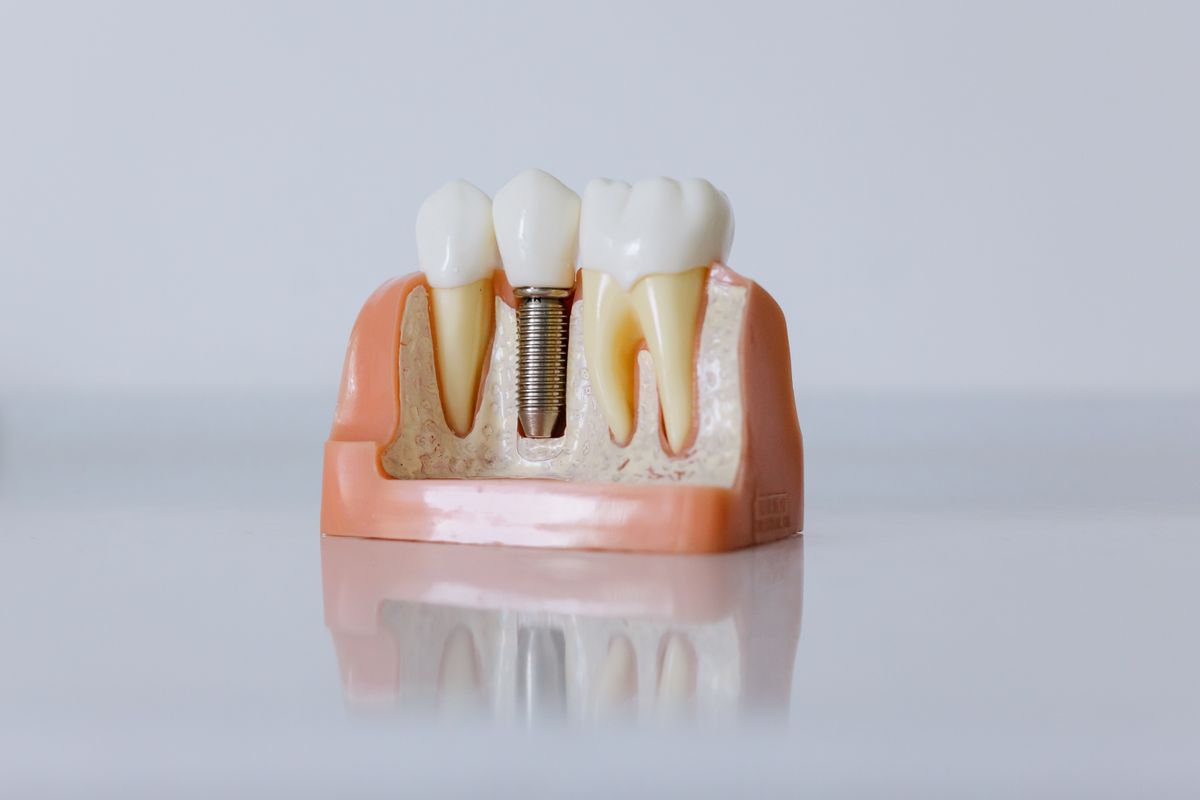 Implant Dentistry